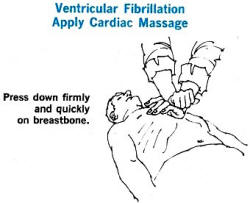 Ventricular Fibrillation, Apply Cardiac Massage - RF Cafe